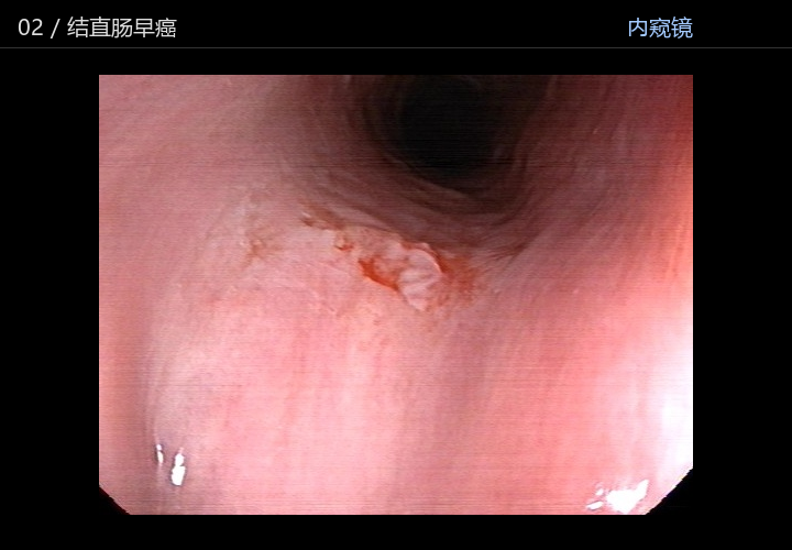 结直肠早癌