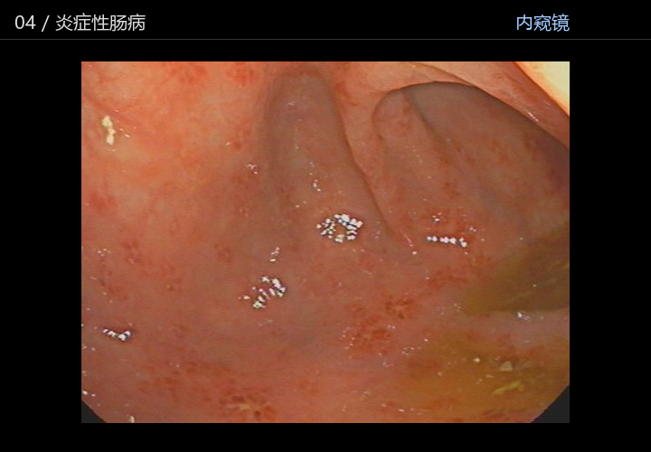 炎症性肠病