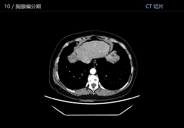 胸腺瘤分期
