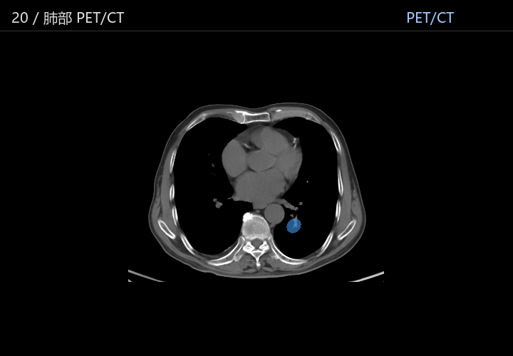肺部 PET/CT